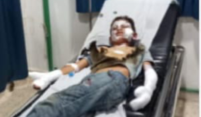 طفل يتعرض إلى إصابات بليغة جرَّاء انفجار بالون حراري
