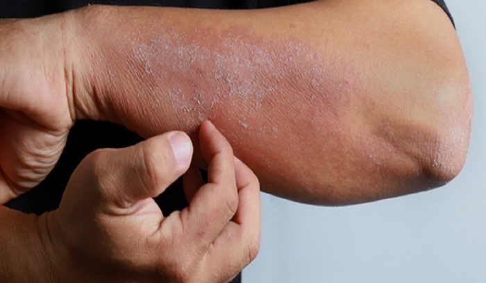 الولايات المتحدة تسجل أول إصابتين بمرض جلدي “خطير”